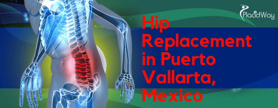 Hip Replacement In Puerto Vallarta, Mexico